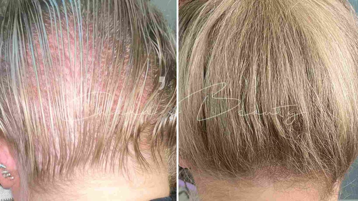 Scalp Micropigmentation